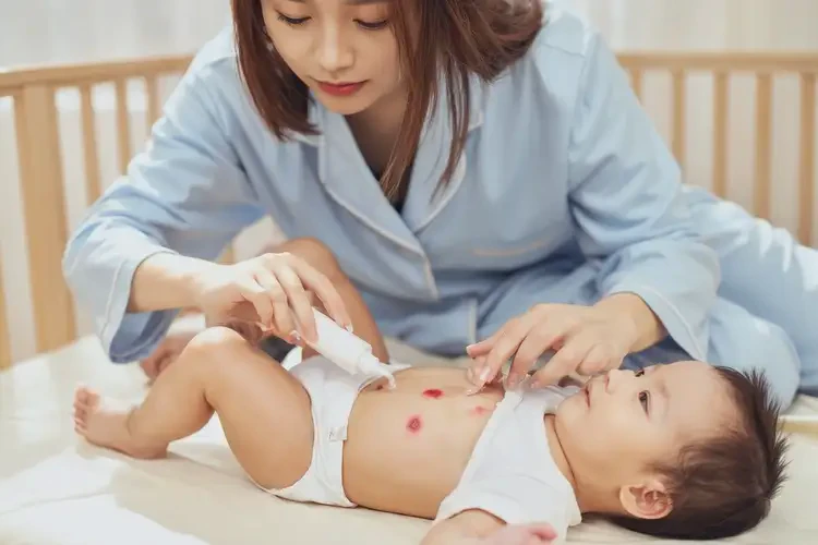小兒肚子容易長濕疹不管它會(huì)自己痊愈嗎(圖3)