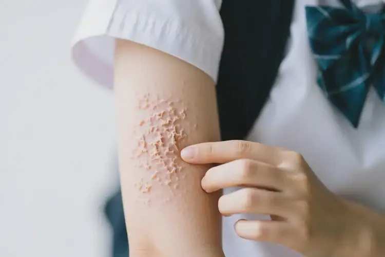 大學(xué)生手臂起濕疹可不可以徹底自愈(圖3)