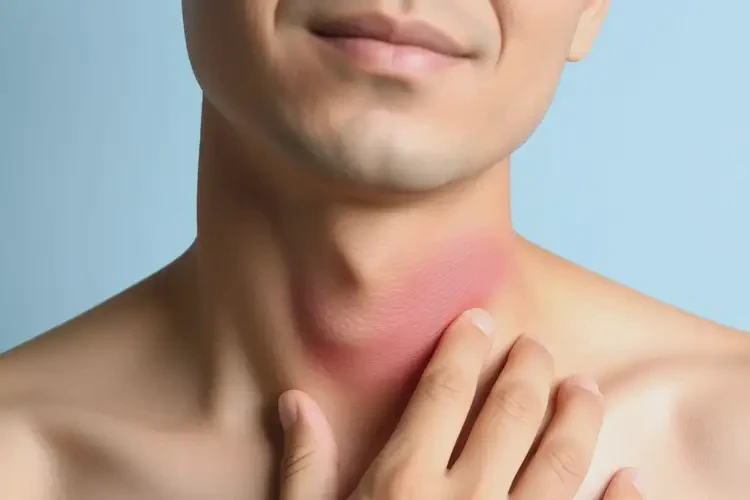 男人脖子起濕疹能徹底自愈嗎(圖2)