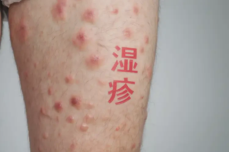 男性大腿經(jīng)常長濕疹不管它會自己痊愈嗎(圖4)