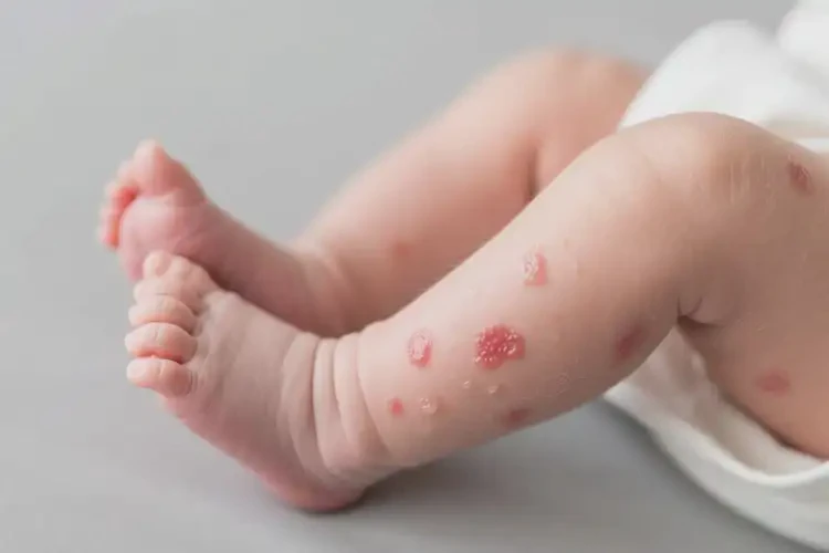 新生兒大腿上偶爾起濕疹可不可以徹底自愈(圖1)