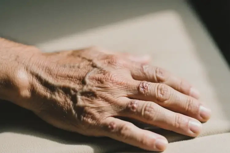 男人手上長(zhǎng)濕疹可不可以徹底自愈(圖2)