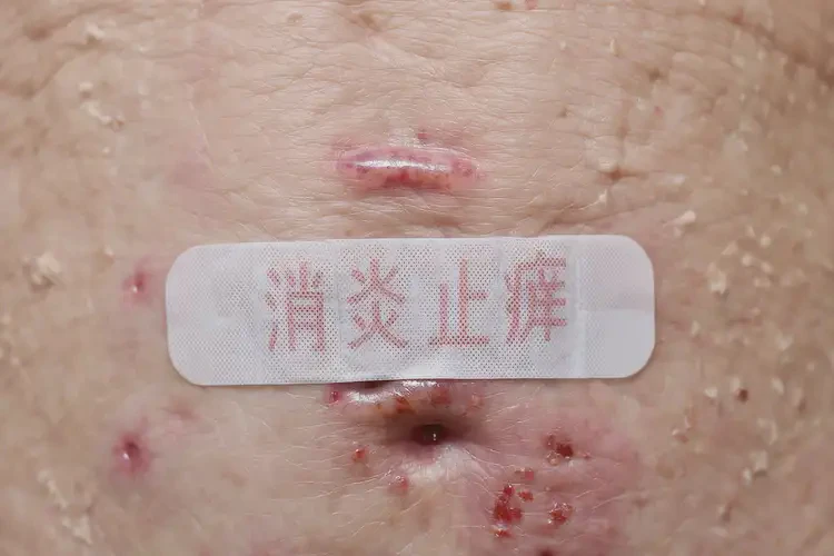 老年人肛周经常起湿疹不管它会自己痊愈吗(图4)