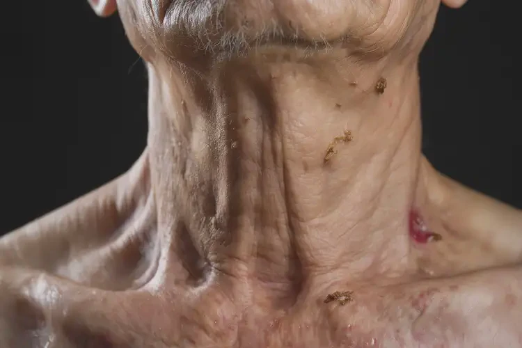 老人脖子上經(jīng)常起濕疹能靠自己自愈嗎(圖4)