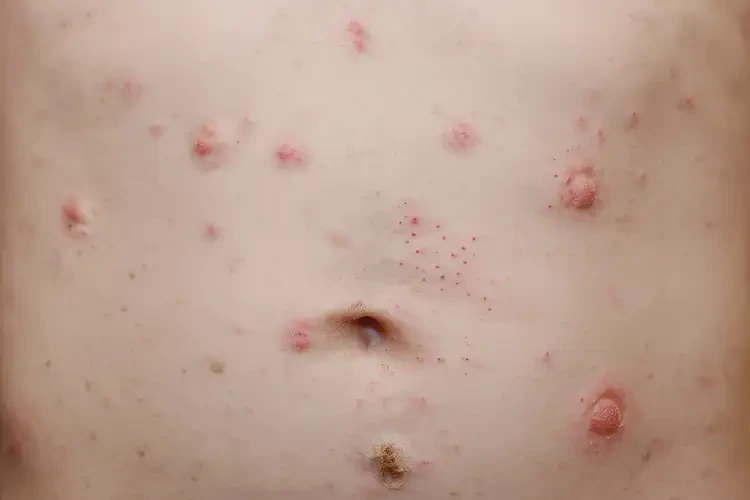 少兒肚子上經(jīng)常起濕疹不管它會(huì)自己自愈嗎(圖4)