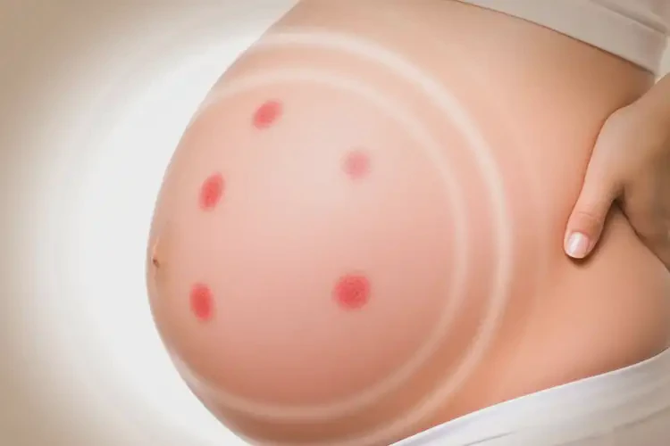 產(chǎn)婦肚子上偶爾起濕疹能靠自己自愈嗎(圖2)