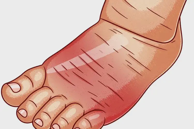 幼兒腳上容易起濕疹可不可以徹底自愈(圖3)