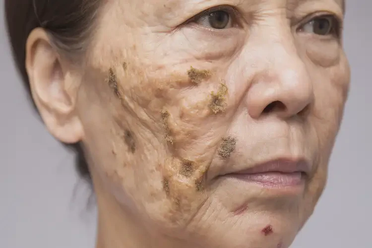 女生面部有濕疹不管它會自己好嗎(圖2)