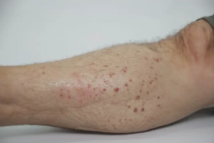 男性小腿上偶爾起濕疹不管它會(huì)自己自愈嗎(圖4)