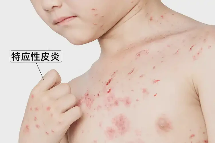 青少年身上有濕疹不管它會自己好嗎(圖4)