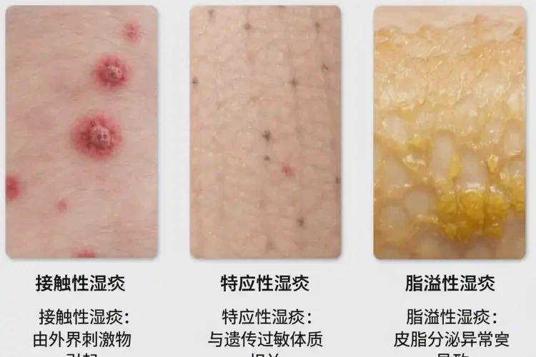 青年人屁股上长湿疹能不能彻底自愈(图2)