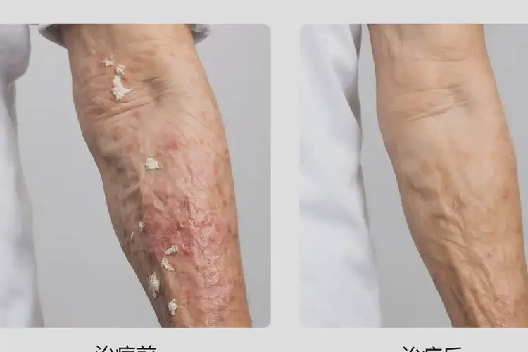 高齡老人四肢出濕疹能徹底自愈嗎(圖1)