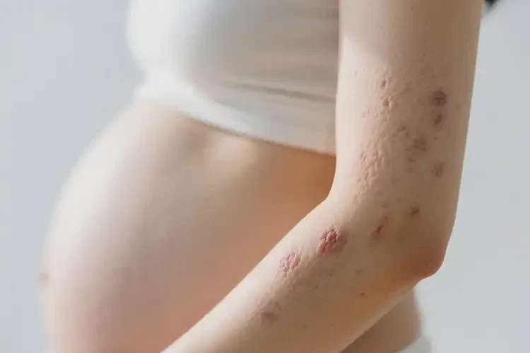 產(chǎn)婦手臂上出濕疹能靠自己自愈嗎(圖4)