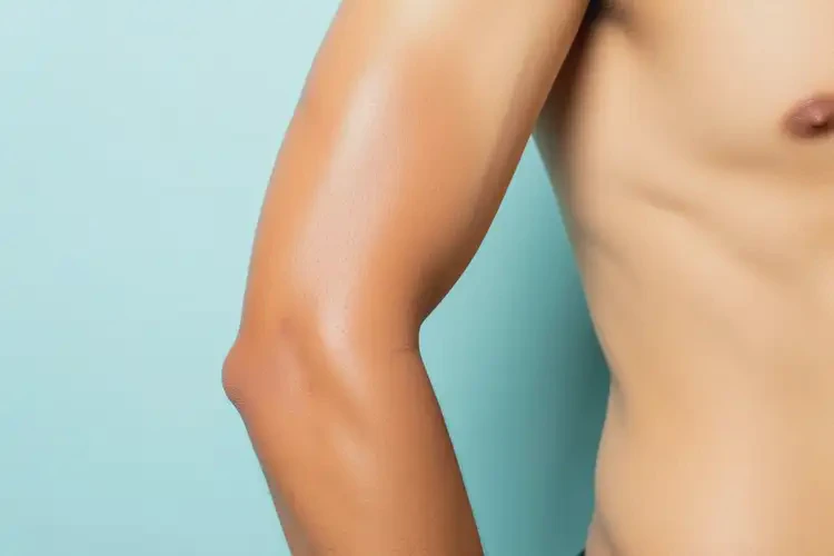 男生手臂上有濕疹能靠自己自愈嗎(圖2)