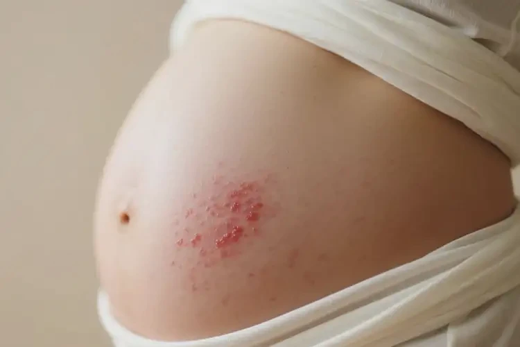 產(chǎn)婦肚子有濕疹能徹底自愈嗎(圖4)