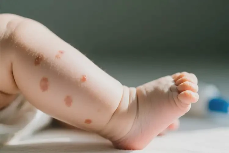 嬰幼兒小腿偶爾長濕疹不管它會自己痊愈嗎(圖3)