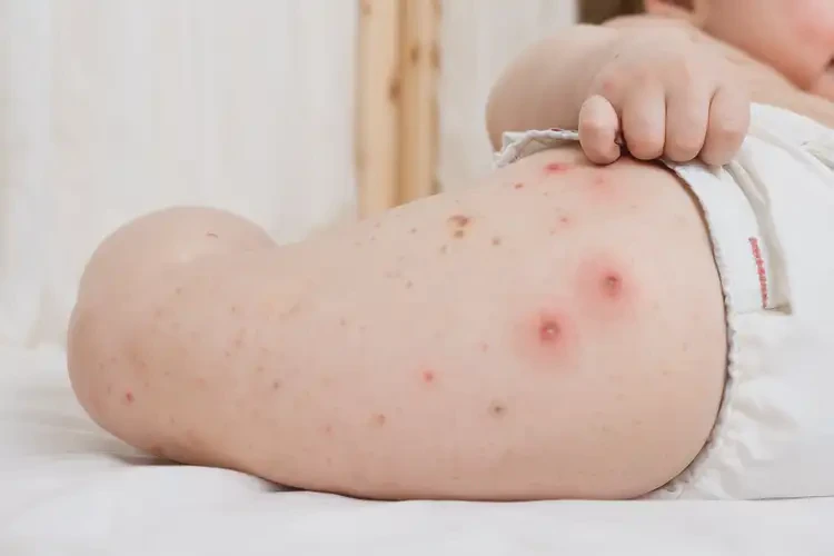 小孩屁股偶爾起濕疹能夠徹底治愈嗎(圖4)