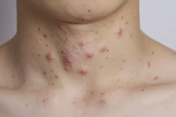 青少年脖子上有濕疹可不可以徹底自愈(圖4)