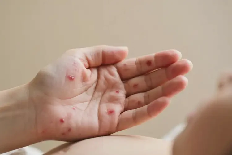 產(chǎn)婦手上長(zhǎng)濕疹不管它會(huì)自己痊愈嗎(圖4)