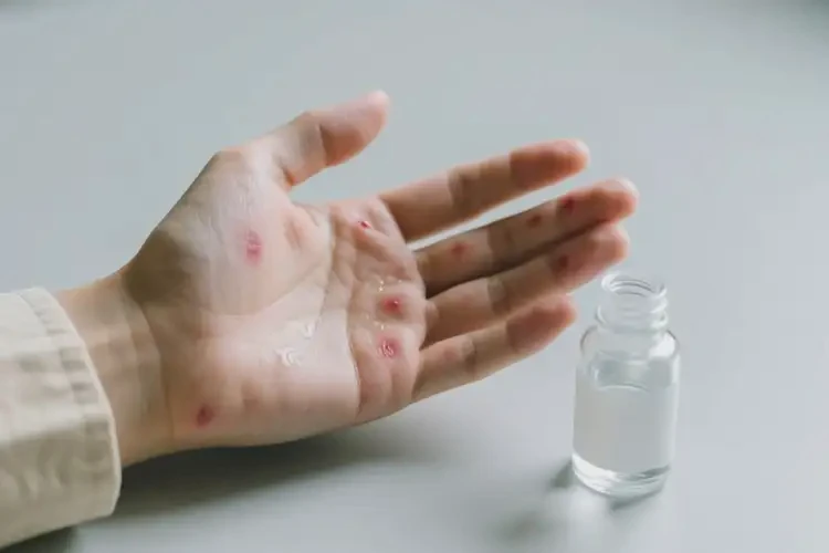 男生手上偶爾起濕疹能夠徹底治愈嗎(圖3)