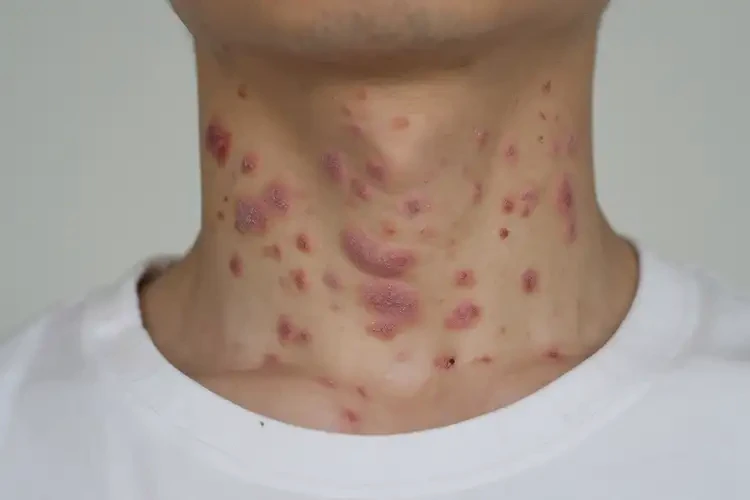 青年人脖子經(jīng)常起濕疹能夠徹底治愈嗎(圖4)