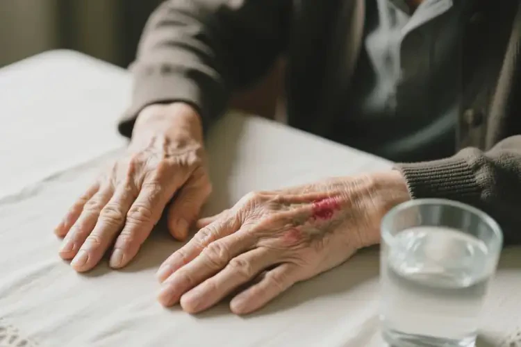 高龄老人四肢偶尔长湿疹能彻底自愈吗(图3)