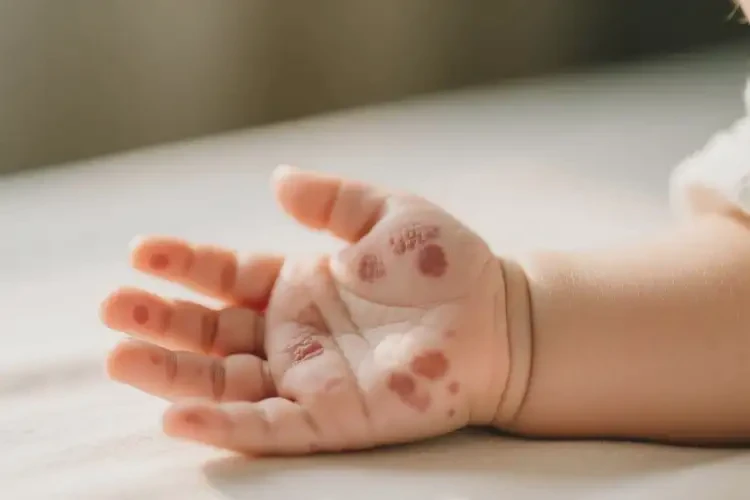 新生兒手上偶爾起濕疹不管它會自己好嗎(圖2)