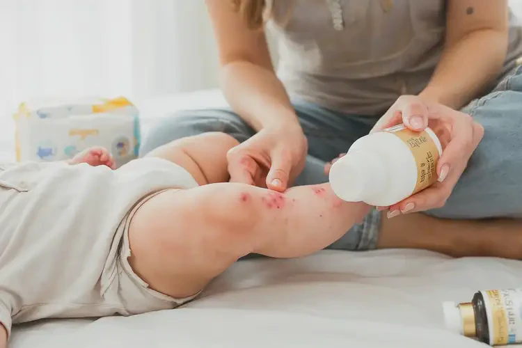 寶寶小腿上容易起濕疹不管它會(huì)自己自愈嗎(圖3)