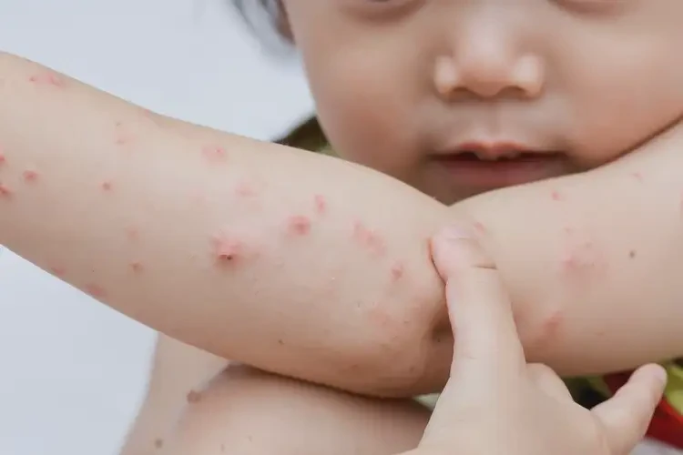 孩子四肢偶爾起濕疹不管它會(huì)自己自愈嗎(圖4)