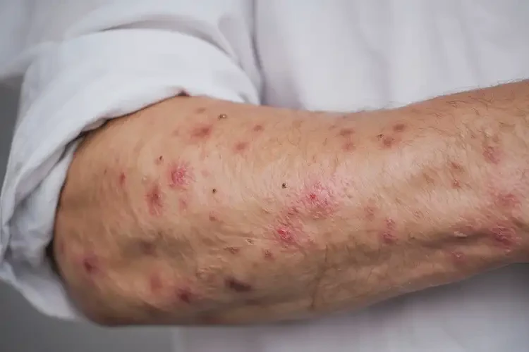 男人手臂起濕疹不管它會自己痊愈嗎(圖4)