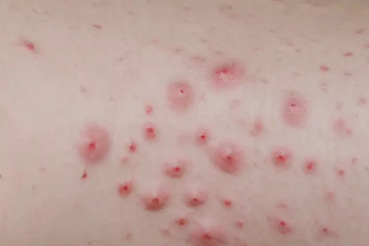 男人肛周长湿疹不管它会自己自愈吗(图4)