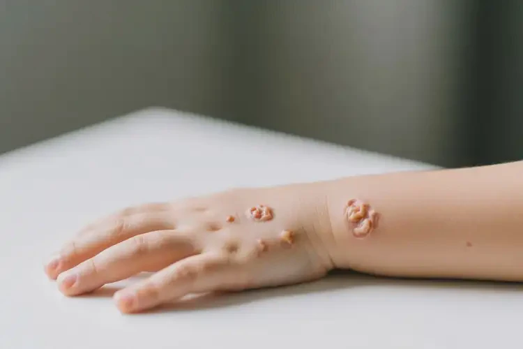 小孩手上出現(xiàn)濕疹不管它會自己好嗎(圖3)