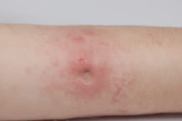 小兒肛周偶爾起濕疹可以徹底自愈嗎(圖4)