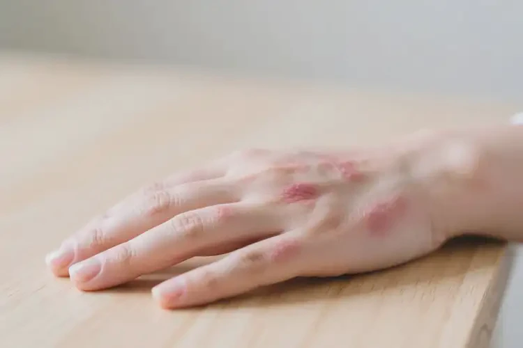 產(chǎn)婦手上長(zhǎng)濕疹不管它會(huì)自己痊愈嗎(圖3)