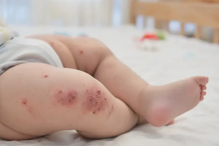 寶寶大腿出現(xiàn)濕疹不管它會自己痊愈嗎(圖4)