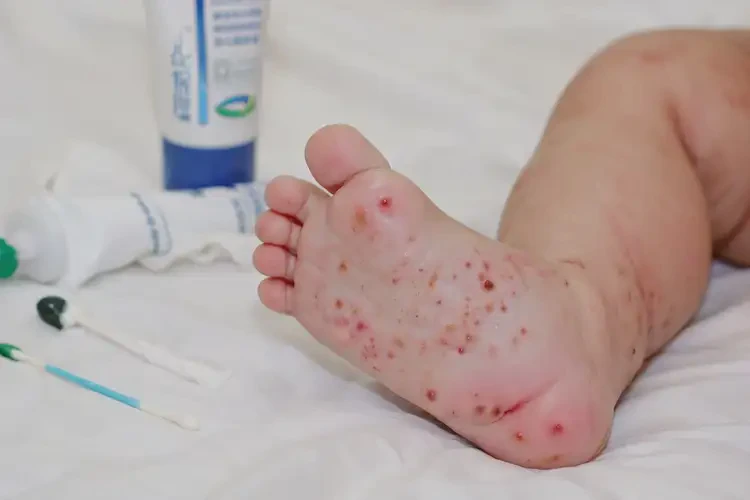 嬰兒小腿上起濕疹能靠自己自愈嗎(圖2)