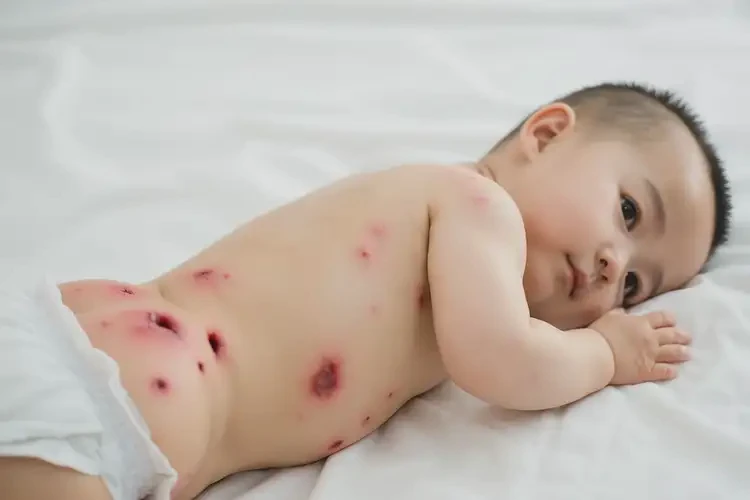 孩子屁股起濕疹不管它會自己好嗎(圖4)