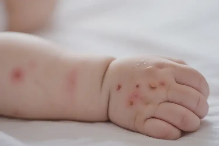 嬰兒手臂經(jīng)常長(zhǎng)濕疹可以徹底自愈嗎(圖4)