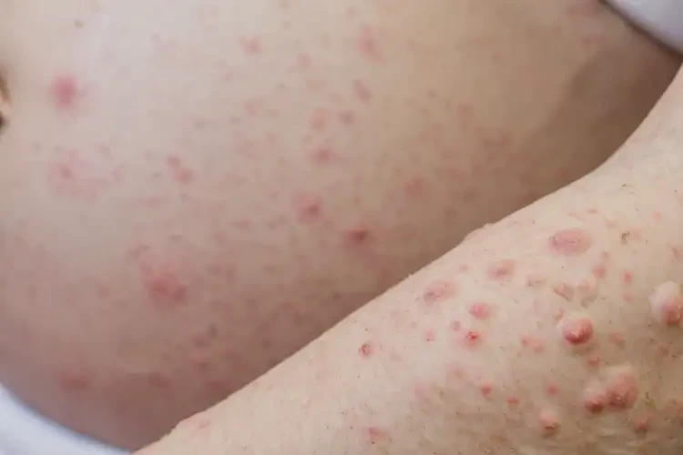 產(chǎn)婦四肢出濕疹能靠自己自愈嗎(圖4)