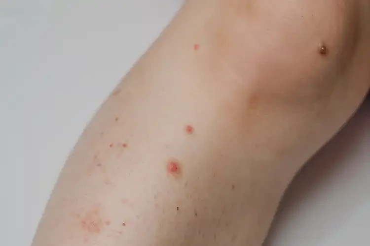 小学生小腿偶尔长湿疹不管它会自己好吗(图4)