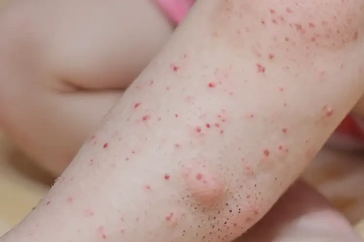 少兒小腿起濕疹能夠徹底治愈嗎(圖4)