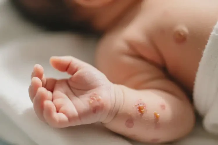 新生兒手上偶爾起濕疹不管它會自己好嗎(圖4)