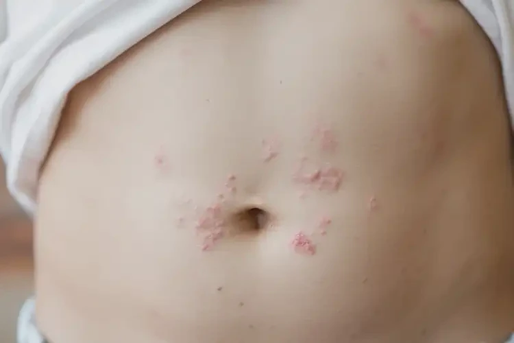 少兒肚子經(jīng)常起濕疹可不可以徹底自愈(圖4)