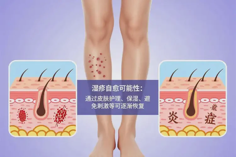 女性小腿上容易起濕疹不管它會自己自愈嗎(圖2)