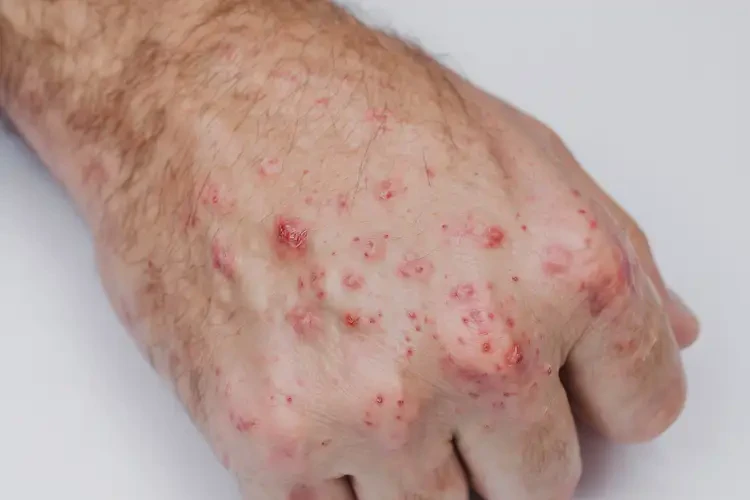 男生手上出濕疹能夠徹底治愈嗎(圖4)