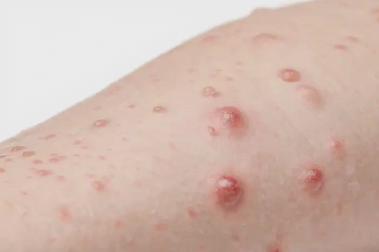 小孩全身起湿疹不管它会自己痊愈吗(图4)