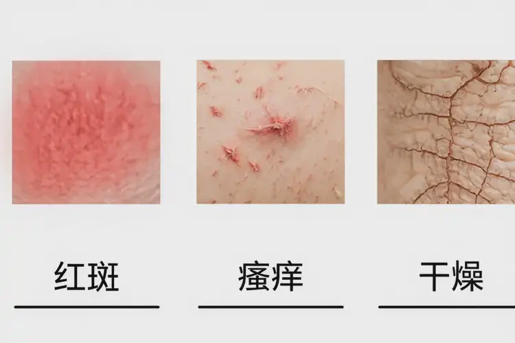 中學(xué)生肚子經(jīng)常長濕疹可以徹底自愈嗎(圖3)