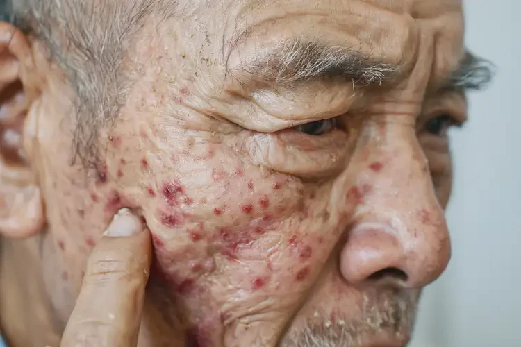 高齡老人脖子偶爾長濕疹不管它會自己痊愈嗎(圖4)