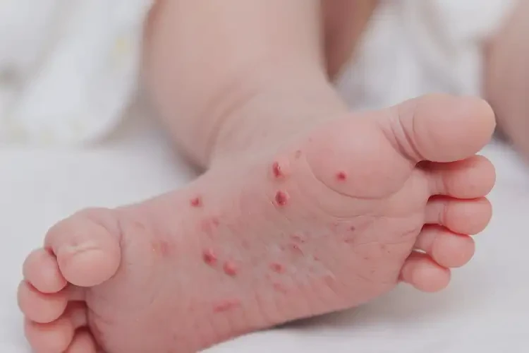 新生兒腳上偶爾起濕疹不管它會(huì)自己痊愈嗎(圖4)