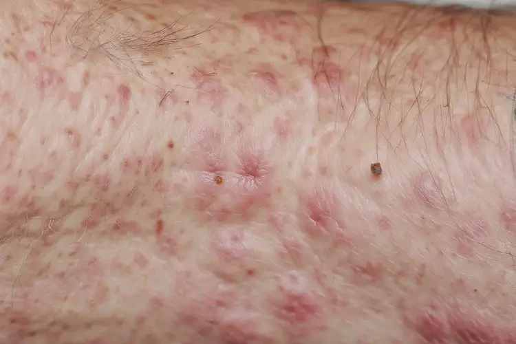 老年人臉上容易起濕疹不管它會自己痊愈嗎(圖4)